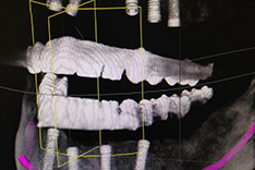 Digitale dreidimensionale Implantatplanung