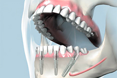 Darstellung einer All-on-4 Implantatversorgung